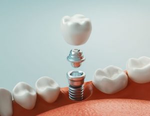 Implantes - Clínica Dental Ensanche de Vallecas