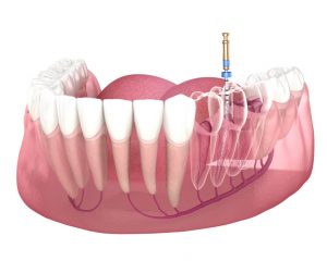 Endodoncia - Clínica Dental Ensanche de Vallecas