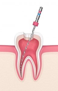 Endodoncia - Clínica Dental Ensanche de Vallecas