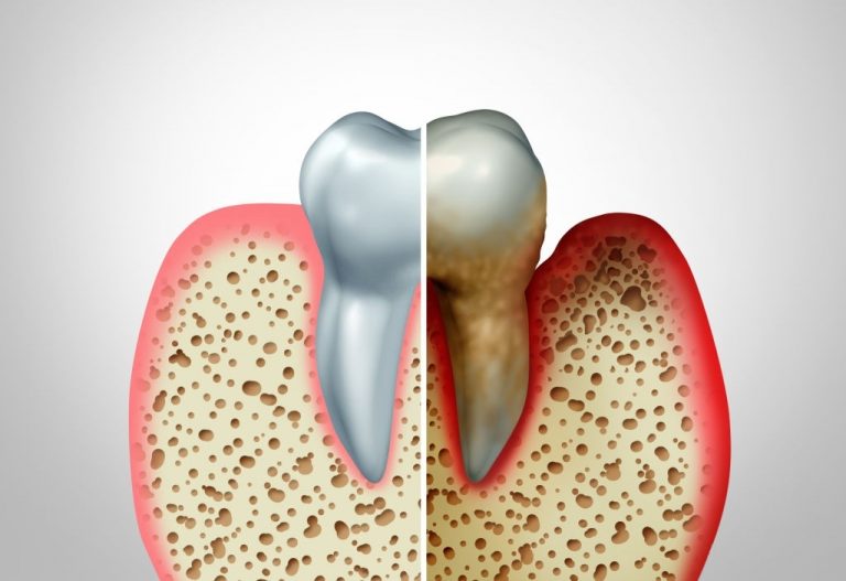 Periodoncia - Clínica Dental Ensanche de Vallecas