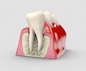 Periodoncia - Clínica Dental Ensanche de Vallecas