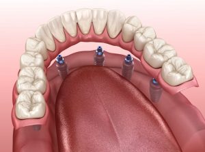 Prótesis dental - Clínica Dental Ensanche de Vallecas