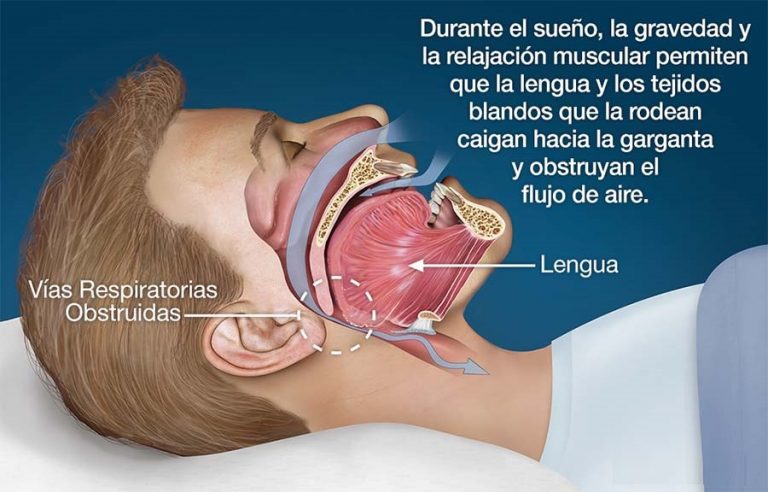 Apnea del sueño - Clínica Dental Ensanche de Vallecas