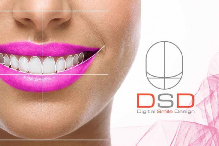 Diseño digital de la sonrisa - Clínica Dental Ensanche de Vallecas