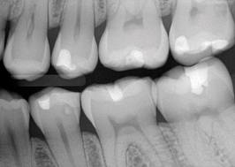 Caries interproximales | Clínica Dental Ensanche de Vallecas