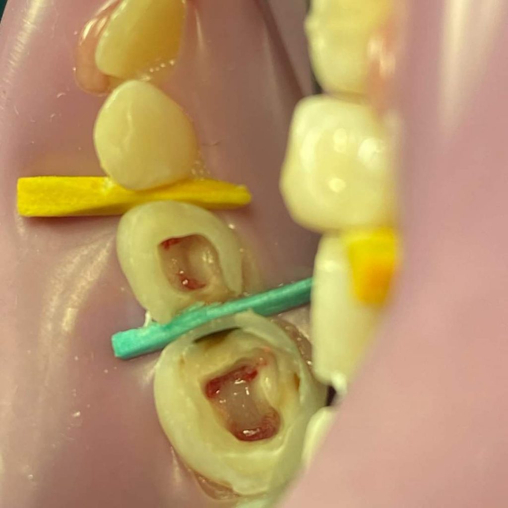 Pulpectomia | Clínica Dental Ensanche de Vallecas