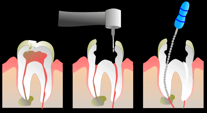 Pulpectomia | Clínica Dental Ensanche de Vallecas