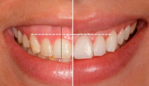 Alargamiento coronario | Clínica Dental Ensanche de Vallecas