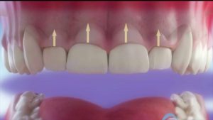 Alargamiento coronario | Clínica Dental Ensanche de Vallecas