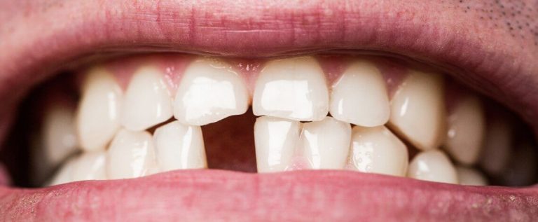 Perdida de diente | Clínica Dental Ensanche de Vallecas