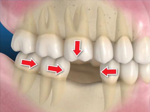 Perdida de diente | Clínica Dental Ensanche de Vallecas