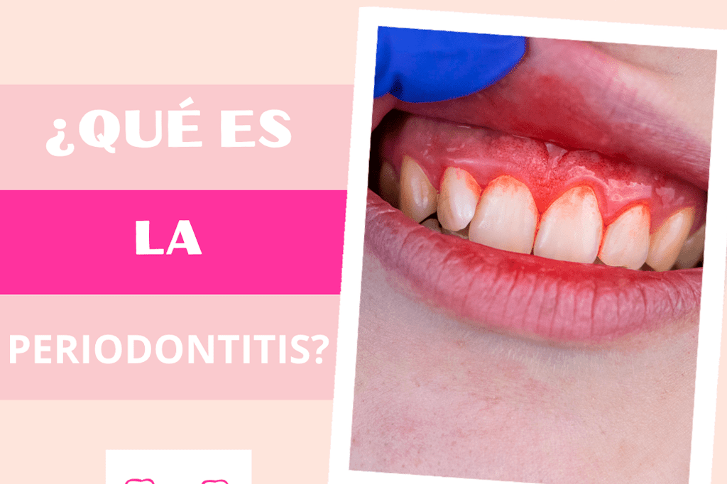 ¿Qué es la periodontitis y cómo tratarla?