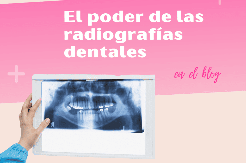 La Importancia de las Radiografías Dentales: Detectando Sonrisas Saludables en la Clínica Dental Ensanche de Vallecas